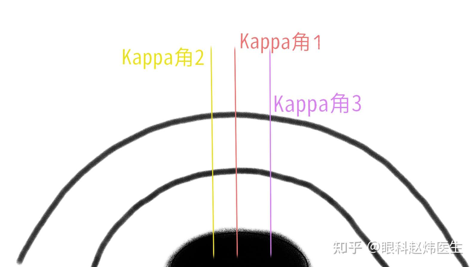 kappa角与斜视图片