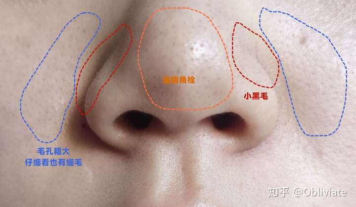 我這個黑頭毛孔怎麼改善呀,毛孔裡還有黑毛,有些絕望呀?