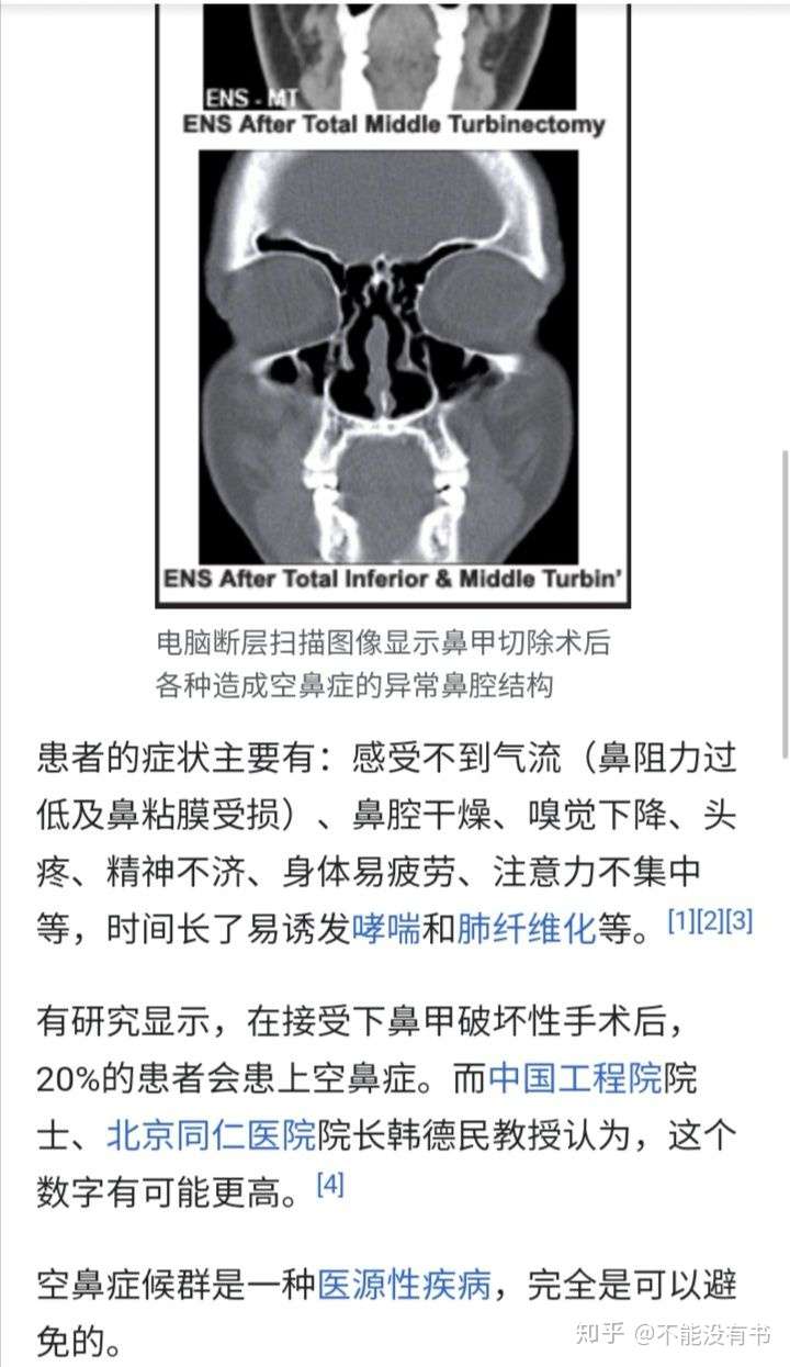 空鼻症候群 英语 Empty Nose Syndrome 维基百科 知乎