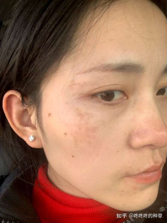 (蝴蝶斑)去年怀孕时候去年刚生完孩子,我来告诉你怎么更快的淡化怀孕