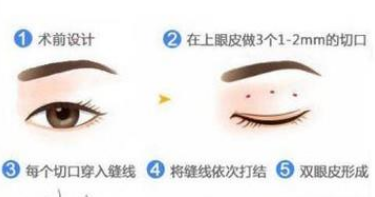 做双眼皮手术多久才能恢复(双眼皮术后多久可以恢复)插图(2) 做双眼皮手术多久才能恢复(双眼皮术后多久可以恢复)插图(2)