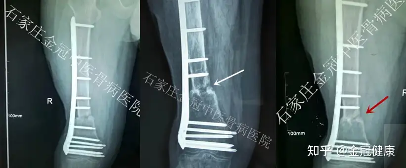 关于骨不连的介绍及分析- 知乎