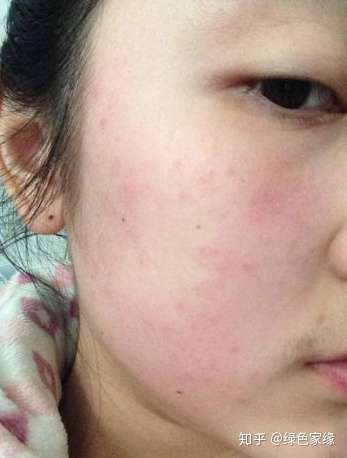 甲醛过敏怎么治疗?