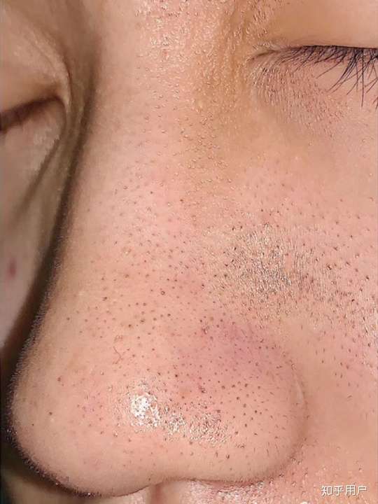 黑头黑头黑头怎么除掉饭前勿进