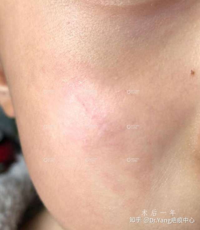 右面部表情凹疤痕修复术后一年