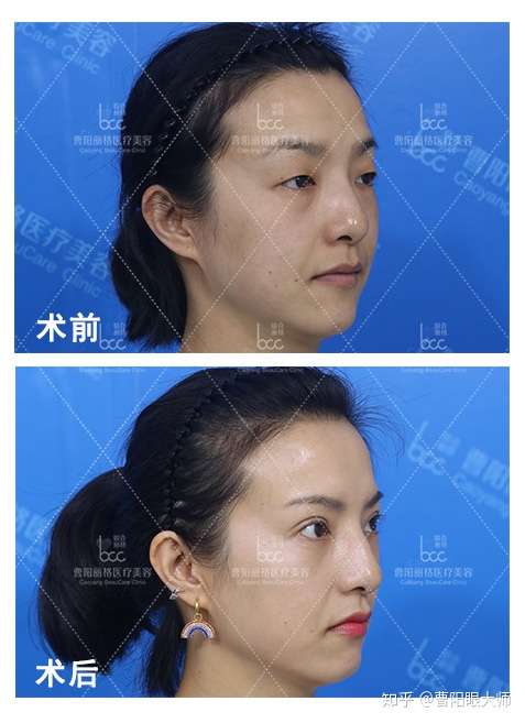 去眼袋手术也会失败吗 知乎