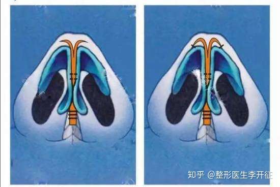 我们以鼻尖为点搭建鼻支架,起到鼻小柱鼻尖自然翘挺的作用的同时,稳固