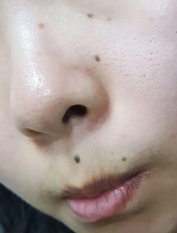 点痣点痣