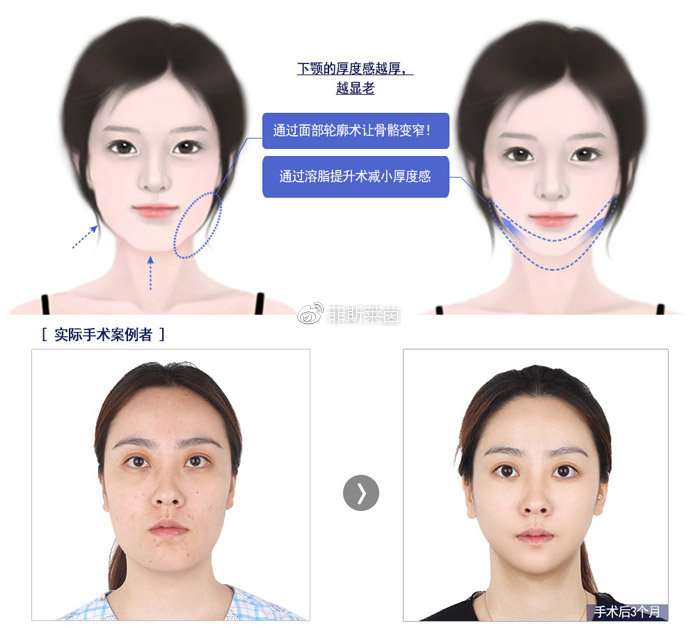 Faceline整形抗老化童颜轮廓术 美容医疗 Ek 乐在韩国 韩国留学生论坛 韩国华人论坛 韩国婚姻 韩国打工网站