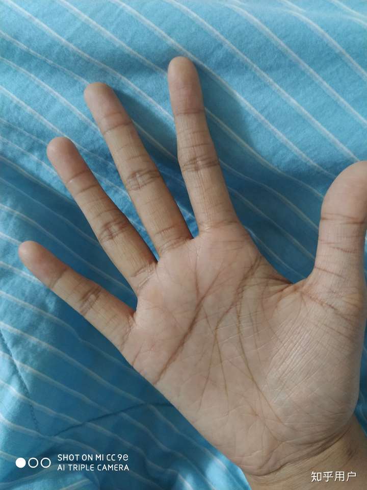 请问鱼鳞病患者的手都是老人手吗