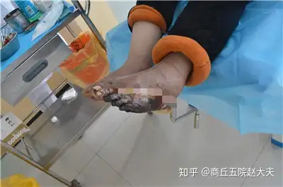 糖尿病患者腳趾出現發黑壞死足背乾裂嚴重嗎