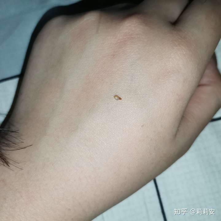 从自己身上扣下来最大的黑头有多大?