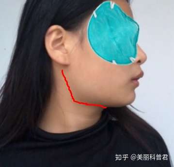 脸方 下巴短 下颌骨大 具体是哪方面导致的呢 ?