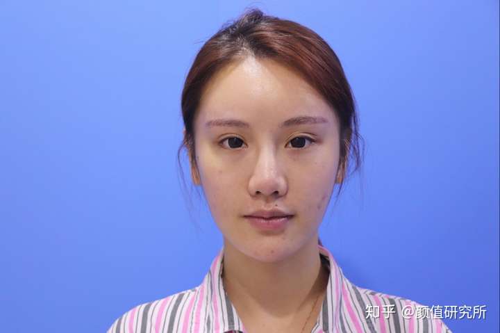 大连哪位医生做面部自体脂肪填充好?