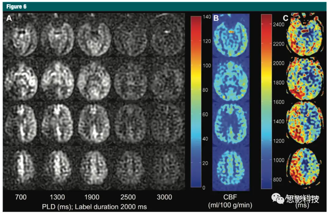 Radiology：大脑动脉自旋标记（ASL)灌注方法介绍- 知乎