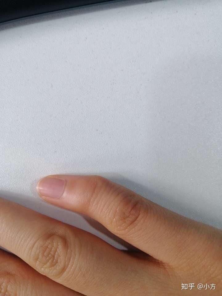 有没有天生小拇指向外弯曲的朋友?