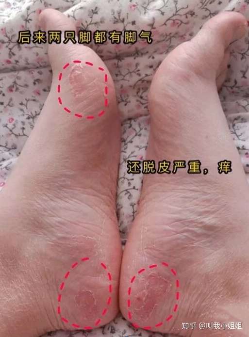 腳氣是怎樣形成的