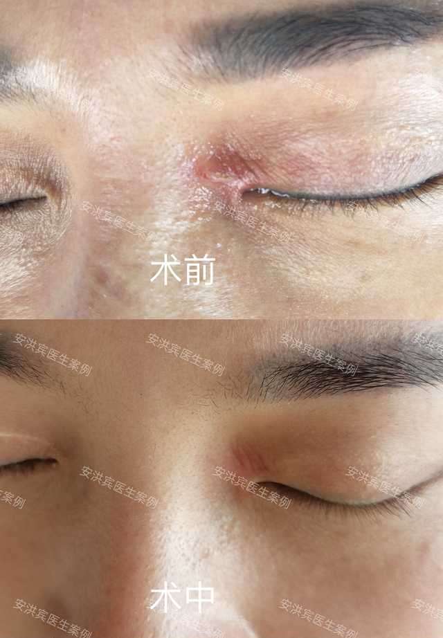 安医生 的想法: 点阵激光治疗去疤痕 | 患者左内眼角美容… - 知乎