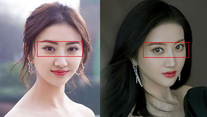 双眼皮过宽可以修窄吗