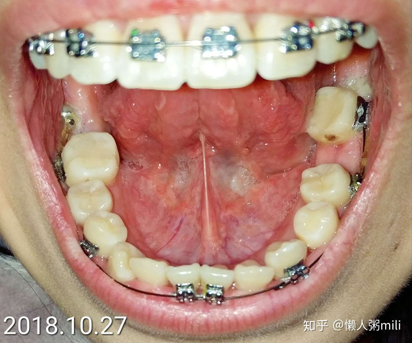 24岁拔磨牙大牙智齿前移替代7号牙牙齿矫正记录 知乎