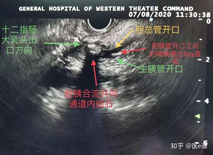 mrcp胆胰管末端充盈缺损性质不明.上周超声内镜发现患