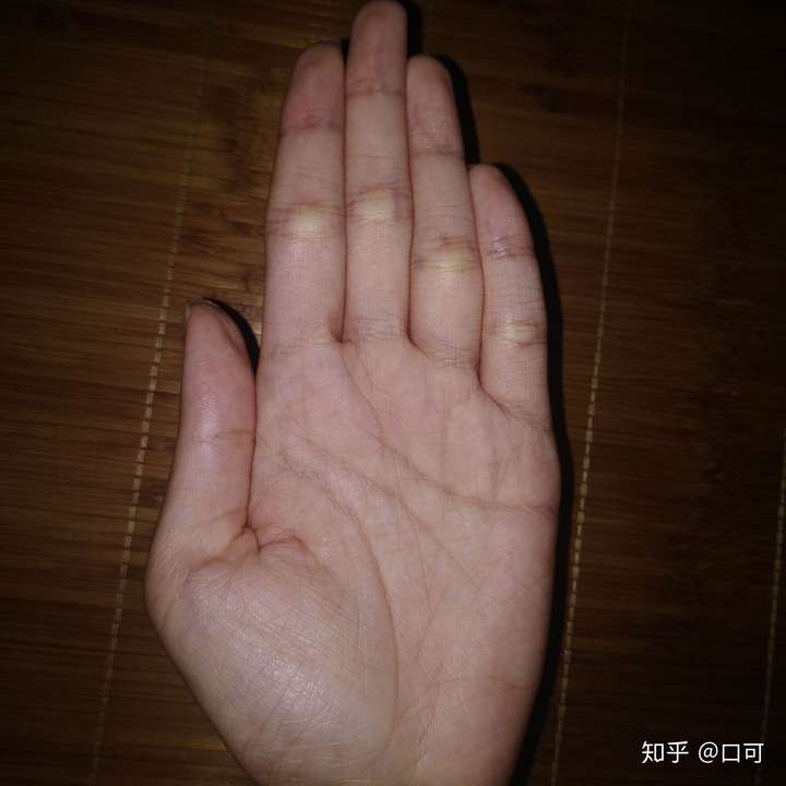 小时候挑过疳积(四缝穴)的人现在都怎样了?