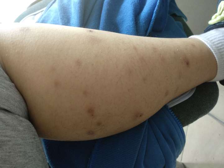 疤痕体质,被蚊虫叮咬或者破皮就会留疤怎么办?