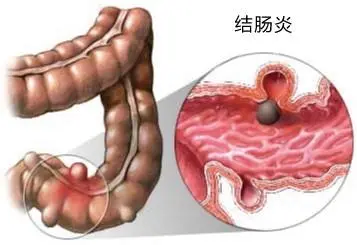 引起慢性结肠炎有哪些原因