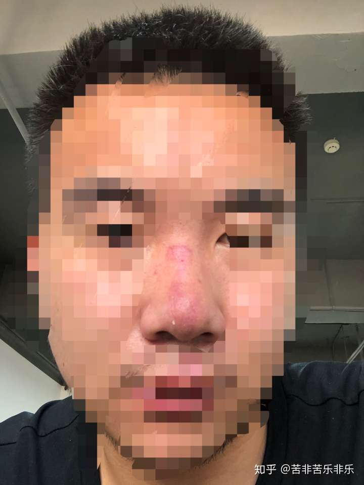 鼻子擦伤 - 知乎