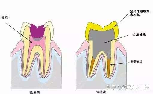 做完根管治疗牙齿一定要打桩治疗吗