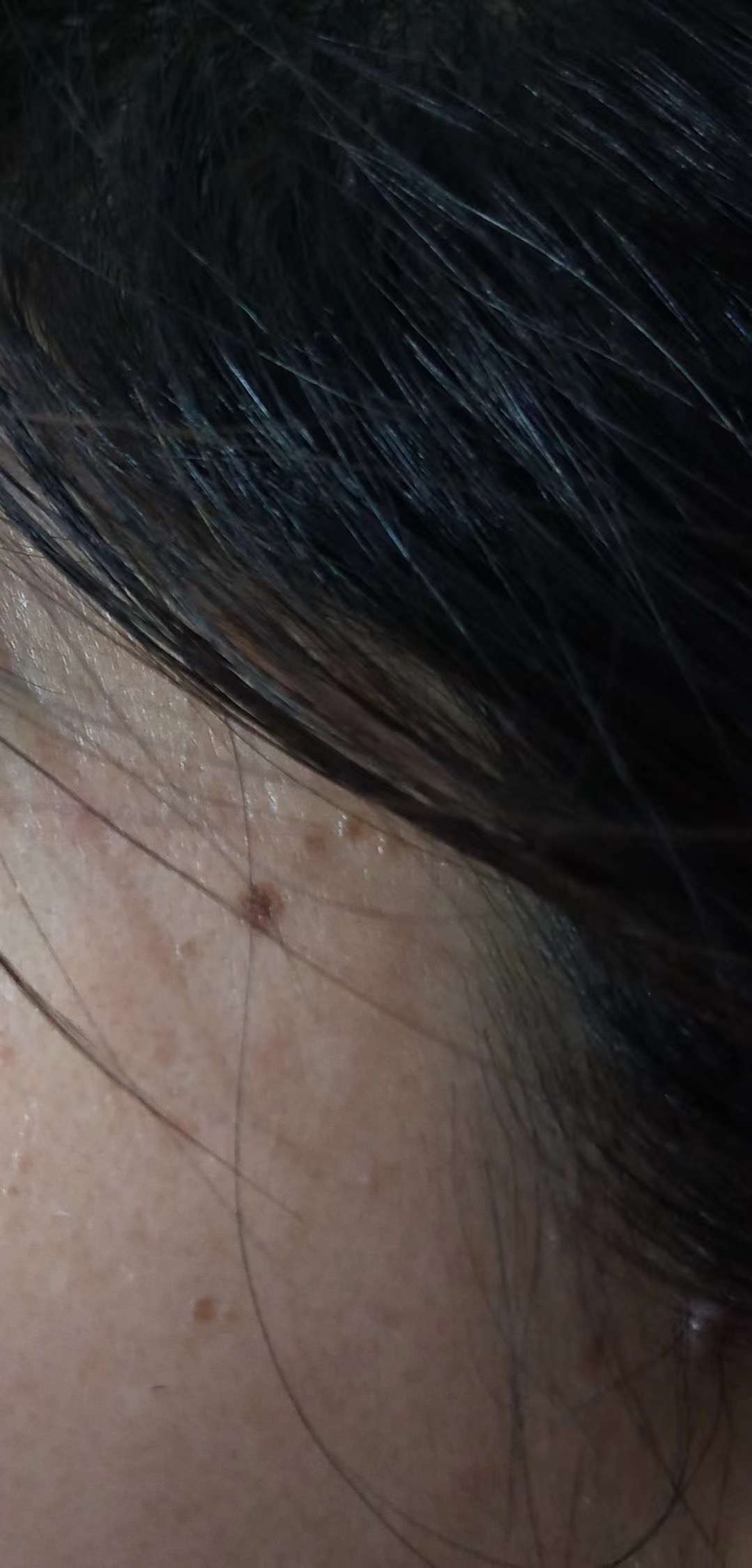 乐肤清颜 的想法: 黑色高起的可能是色素痣,良性, 不必处