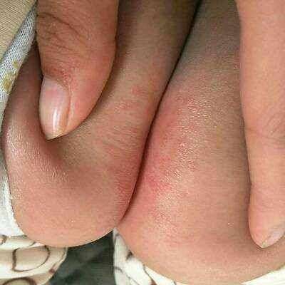 宝宝反复红臀红屁股怎么防怎么治记住8个字就够了