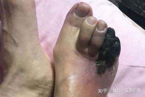 急诊室故事烂脚方知糖尿病