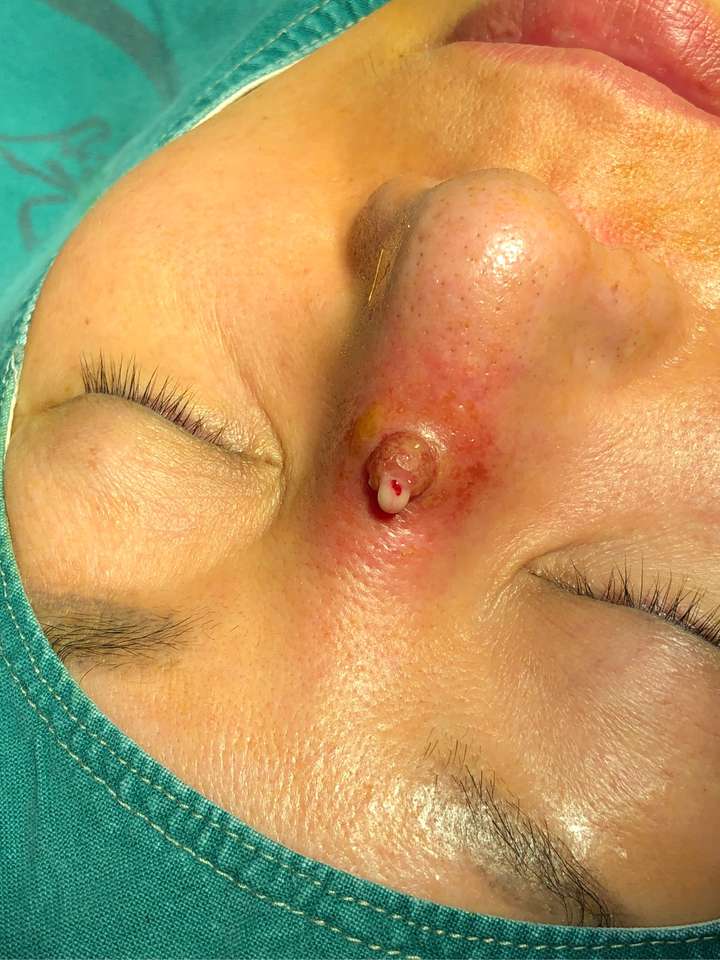 鼻部膨体远期感染率