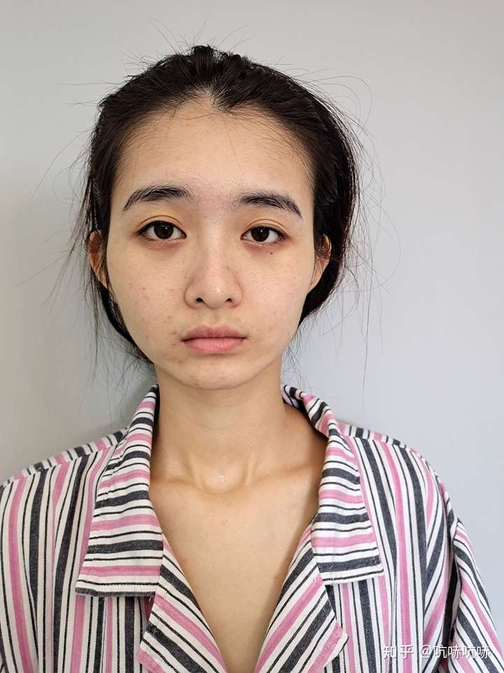 我的脸真的太瘦了,然后脸上好多地方凹陷,面颊凹陷的厉害,连眼窝我都