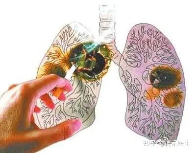 肺癌持有传染性吗？这儿告诉你答案