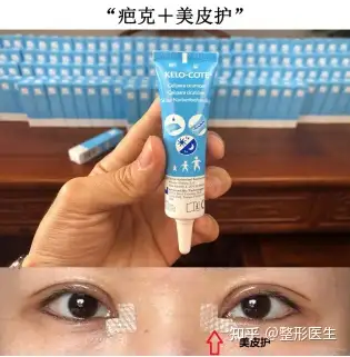 雙眼皮開眼角以後塗疤克有用嗎