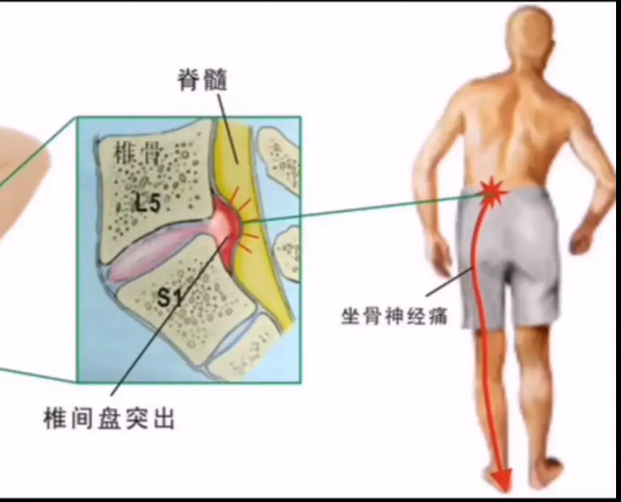 腰椎间盘突出症的自我治疗 患者版 知乎