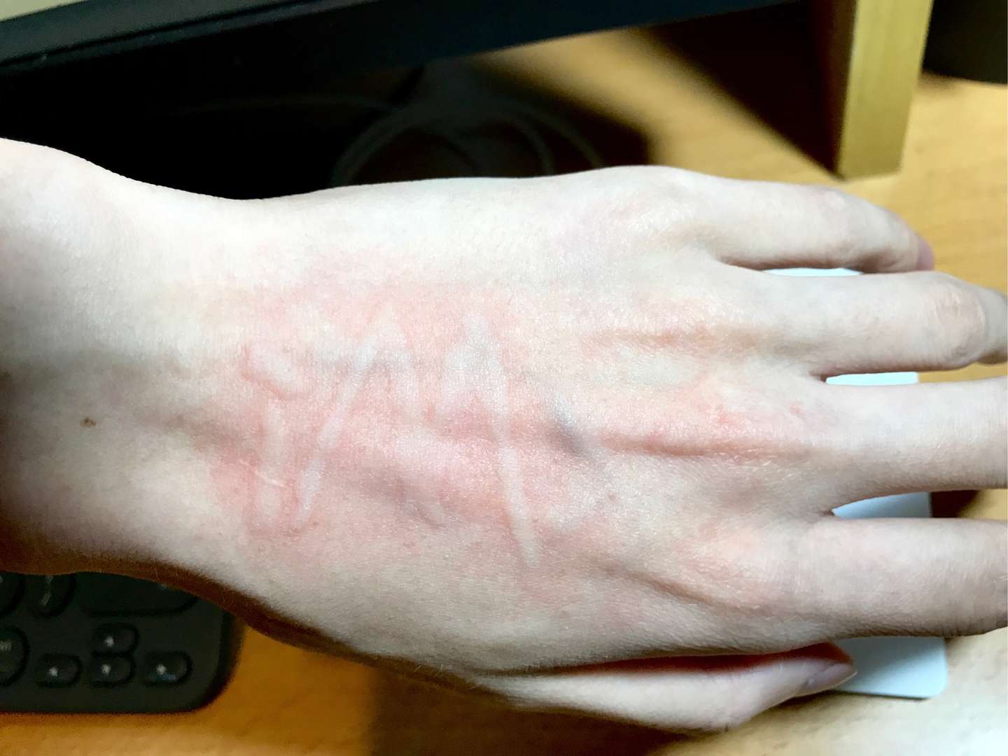 终于明白自己是怎么回事了 皮肤划痕症 知乎