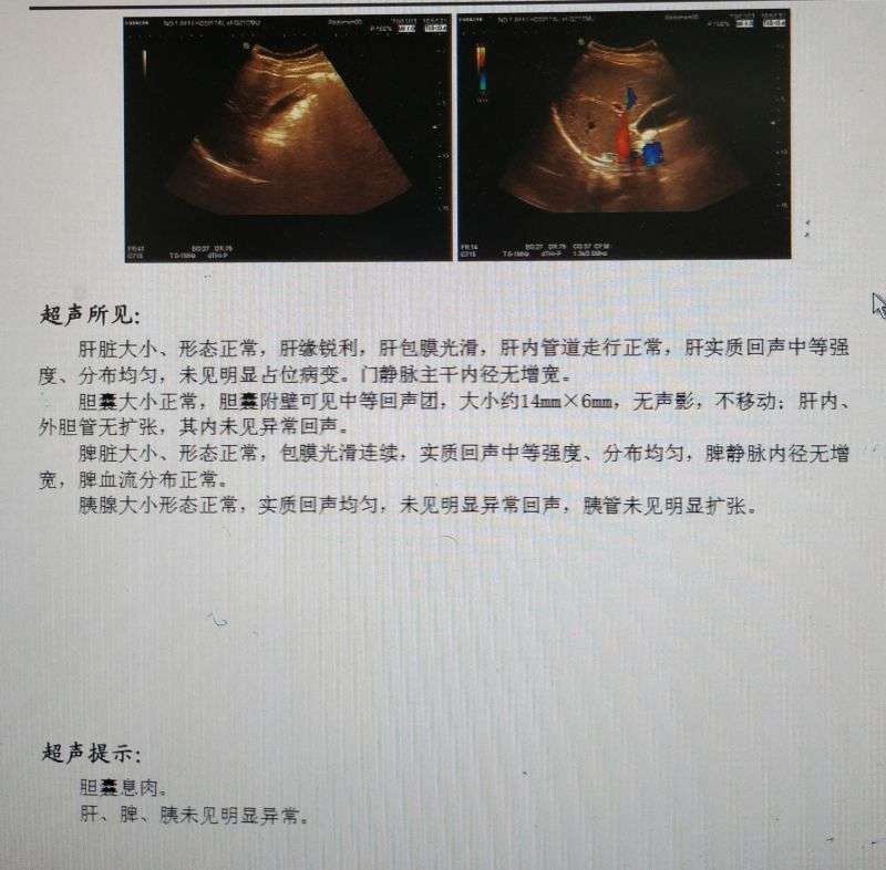体检发现胆囊息肉 怎么办 知乎