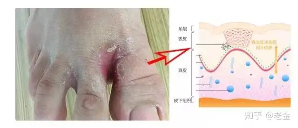 科普 足部皮肤最大的危害 脚气 知乎