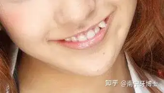 小虎牙的"可爱"与"可恨"——原来它是这样诞生的? - 知乎