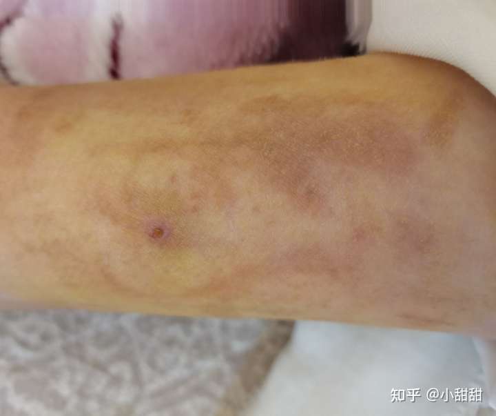 得了癌症是一种怎样的经历 知乎 得了癌症是一种怎样的经历 知乎