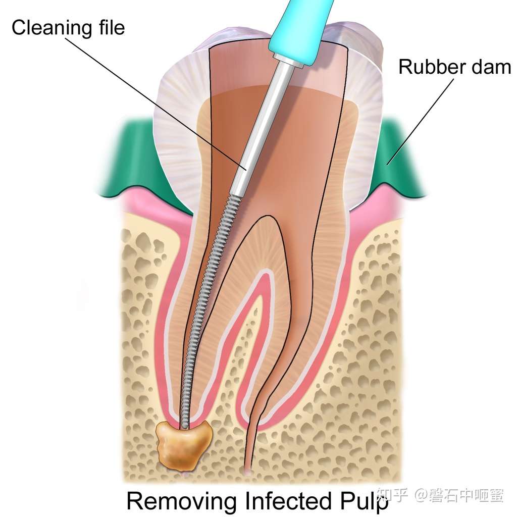 根管治疗root Canal Treatment 知乎