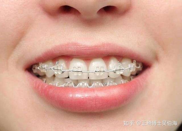 成年人矫正牙齿的三大 后遗症 知乎