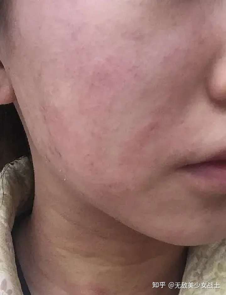 我是长达五年的慢性湿疹,不算特别严重的但是一直都没有解决掉.