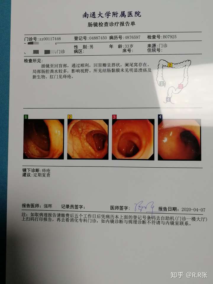 急性肠胃炎是一种怎样的体验?