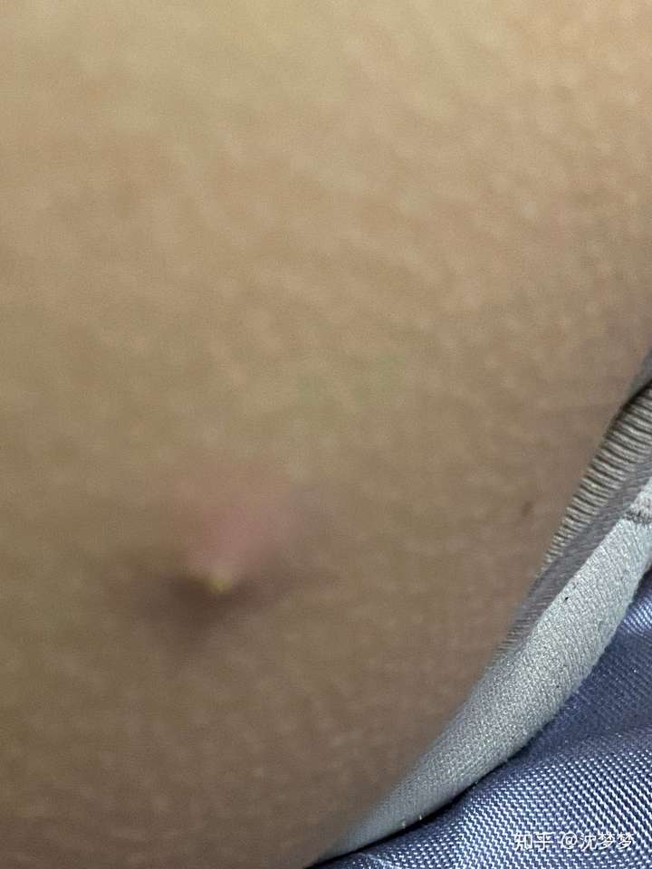 皮脂腺囊肿我该拿你咋办