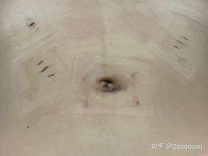 黄体破裂手术疤痕图片图片