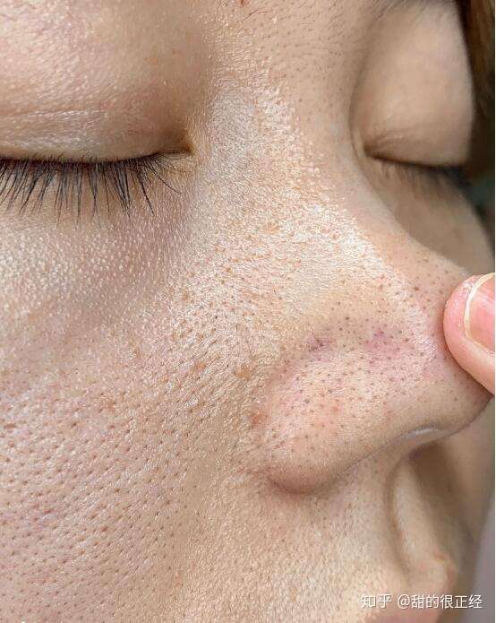 瞅瞅我这个大油田,黑头,毛孔粗大的症状是一个不少!
